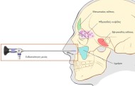 ρινικοί πολύποδες, ένα άλυτο μυστήριο της ιατρικής, επιτέλους λύση και ελληνική